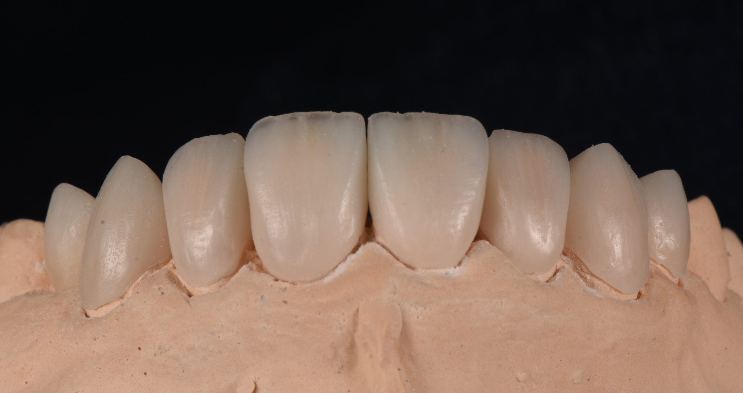 A new porcelain system for micro-layering